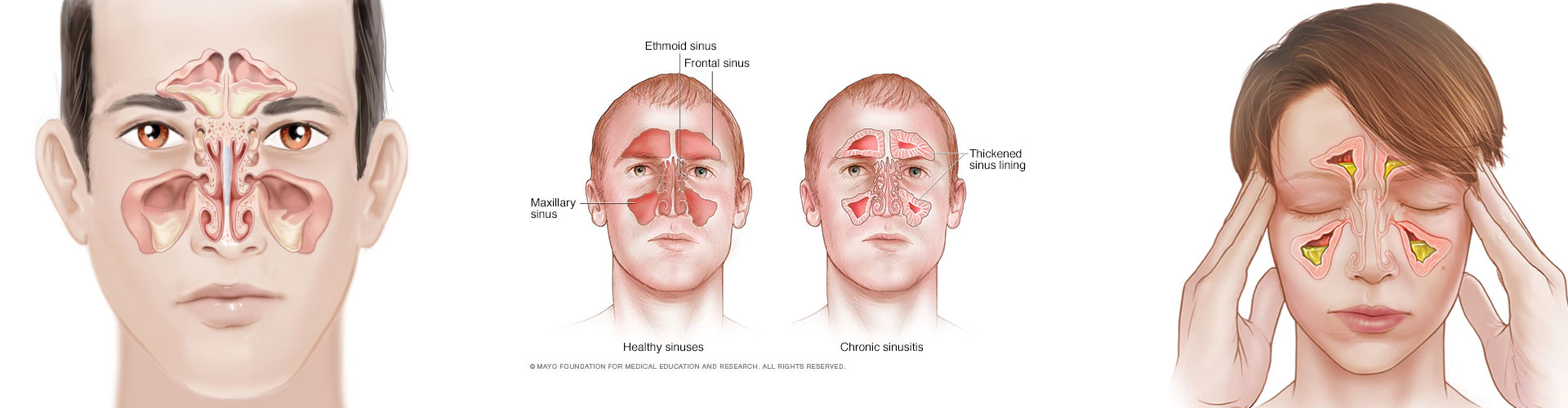 Sinusitis