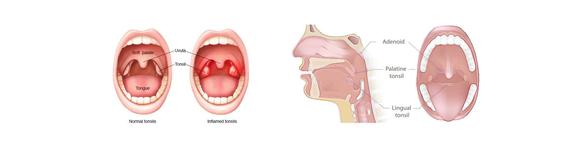 Translitis